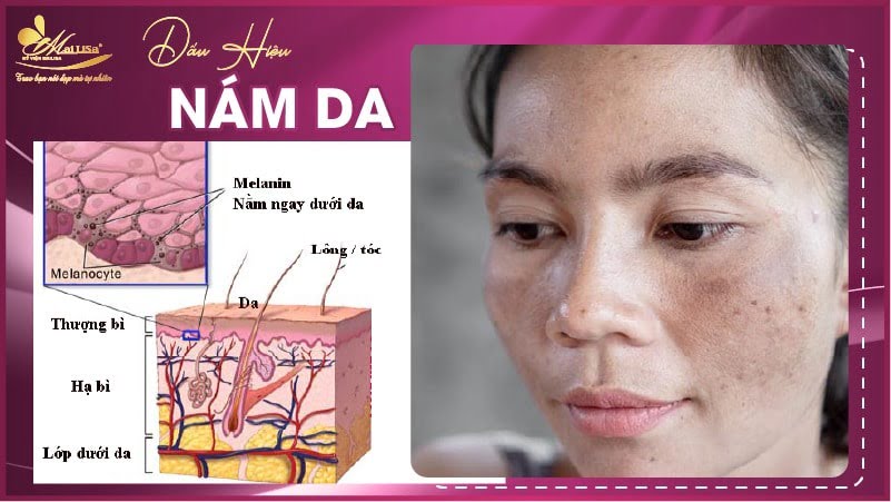  Điều trị nám da hiệu quả với Dr. Hoàng Mạnh Kha