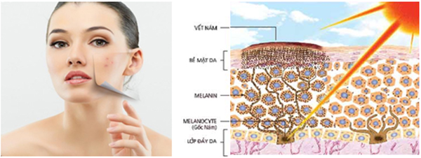  Điều trị nám da hiệu quả với Dr. Hoàng Mạnh Kha