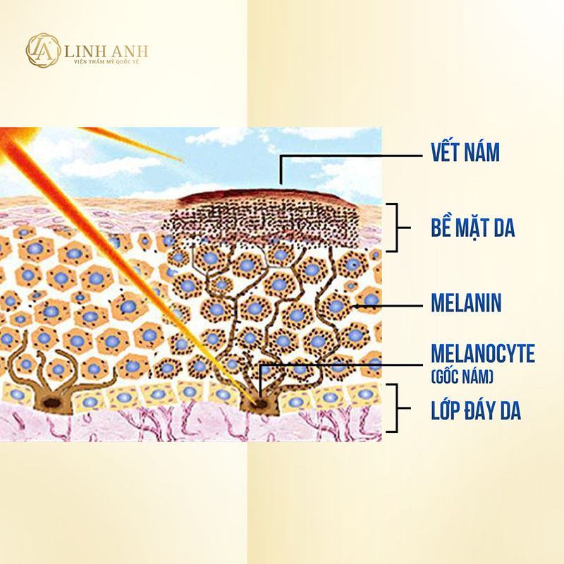  Điều trị nám da hiệu quả với Dr. Hoàng Mạnh Kha