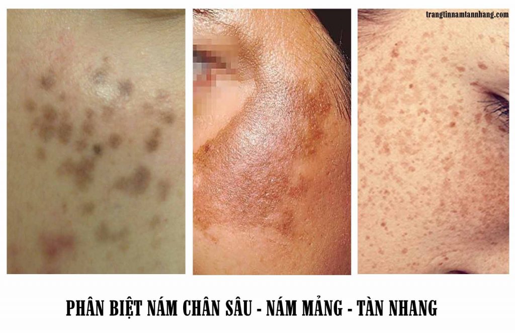  NGUYÊN NHÂN VÀ GIẢI PHÁP TRỊ NÁM HIỆU QUẢ