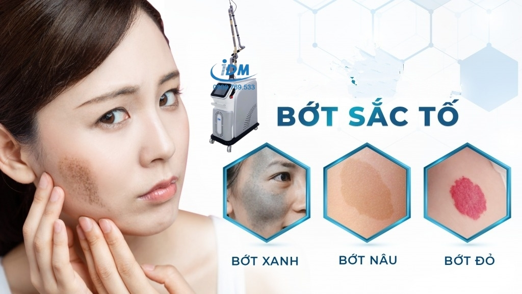 Bớt sắc tố Khám Phá Thế Giới Đằng Sau Những Vết Bớt