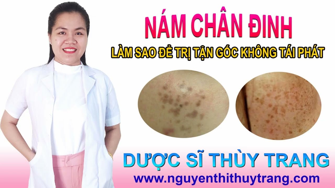 Điều Trị Nám Chân Sâu Giải Pháp Toàn Diện Cho Làn Da Bạn