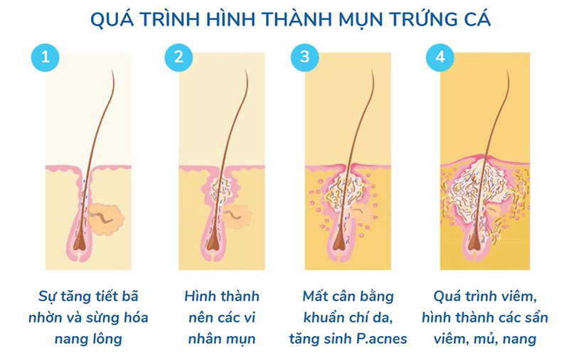 Mụn trứng cá – Những điều cần biết và cách chăm sóc hiệu quả