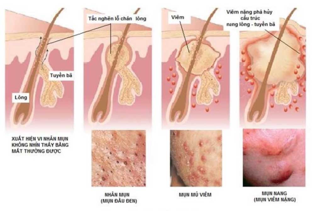 Mụn trứng cá – Những điều cần biết và cách chăm sóc hiệu quả